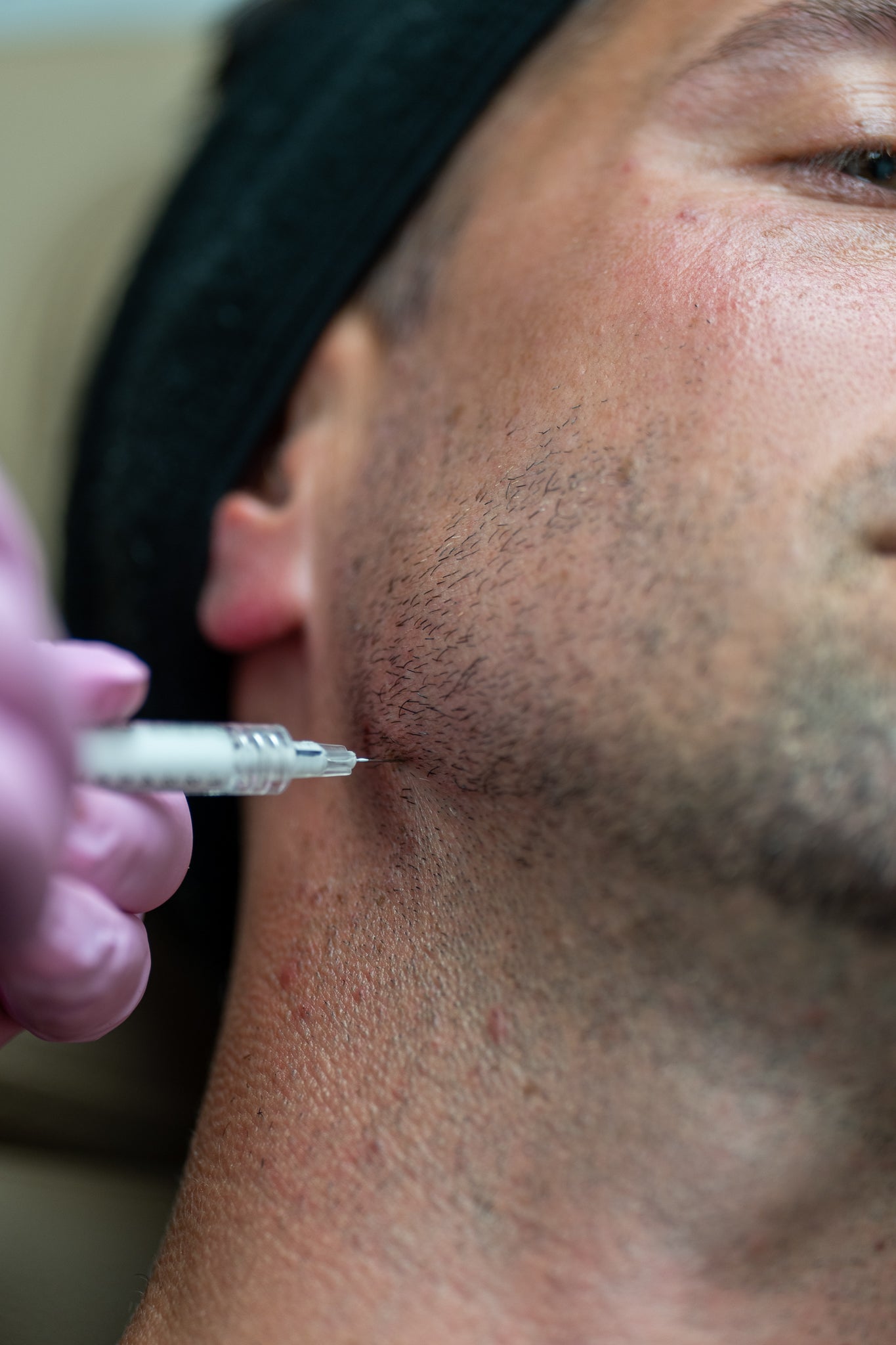 Radiesse vs. Sculptra: Which Filler Is Right for You? | NDA Medical Spa