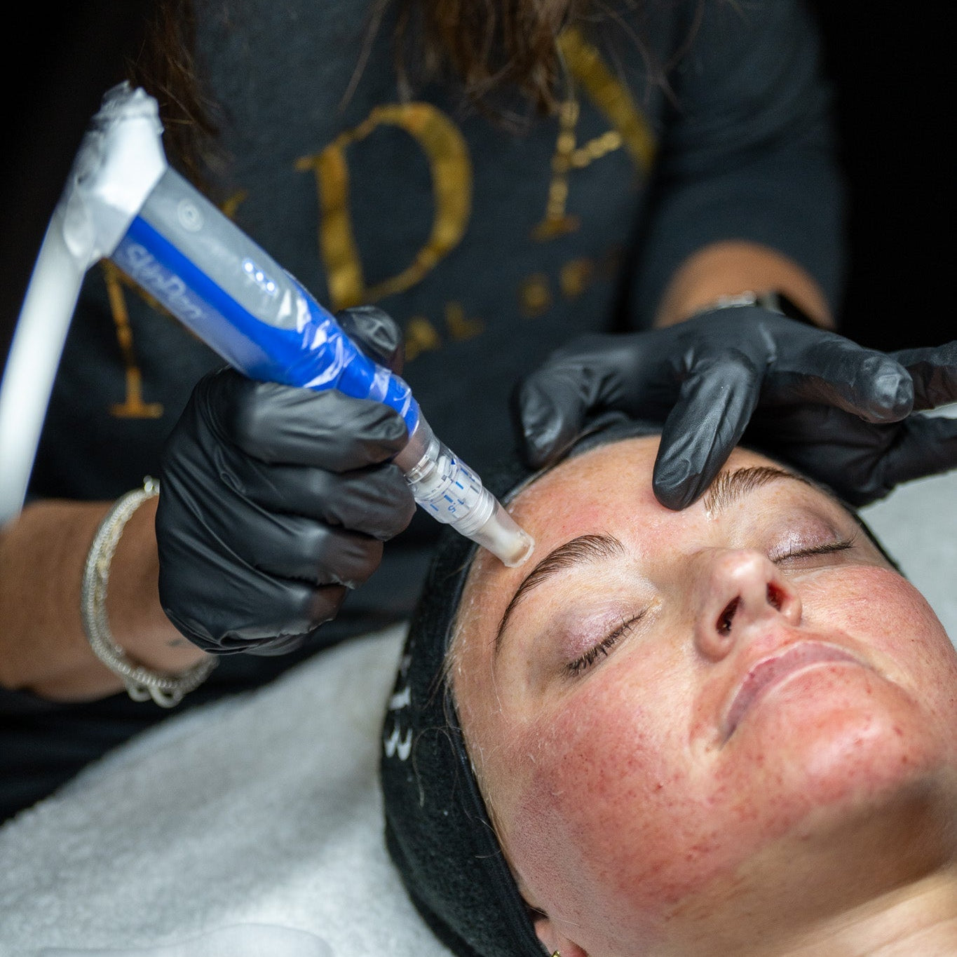 The Benefits of SkinPen: Elevating Your Skincare with Microneedling