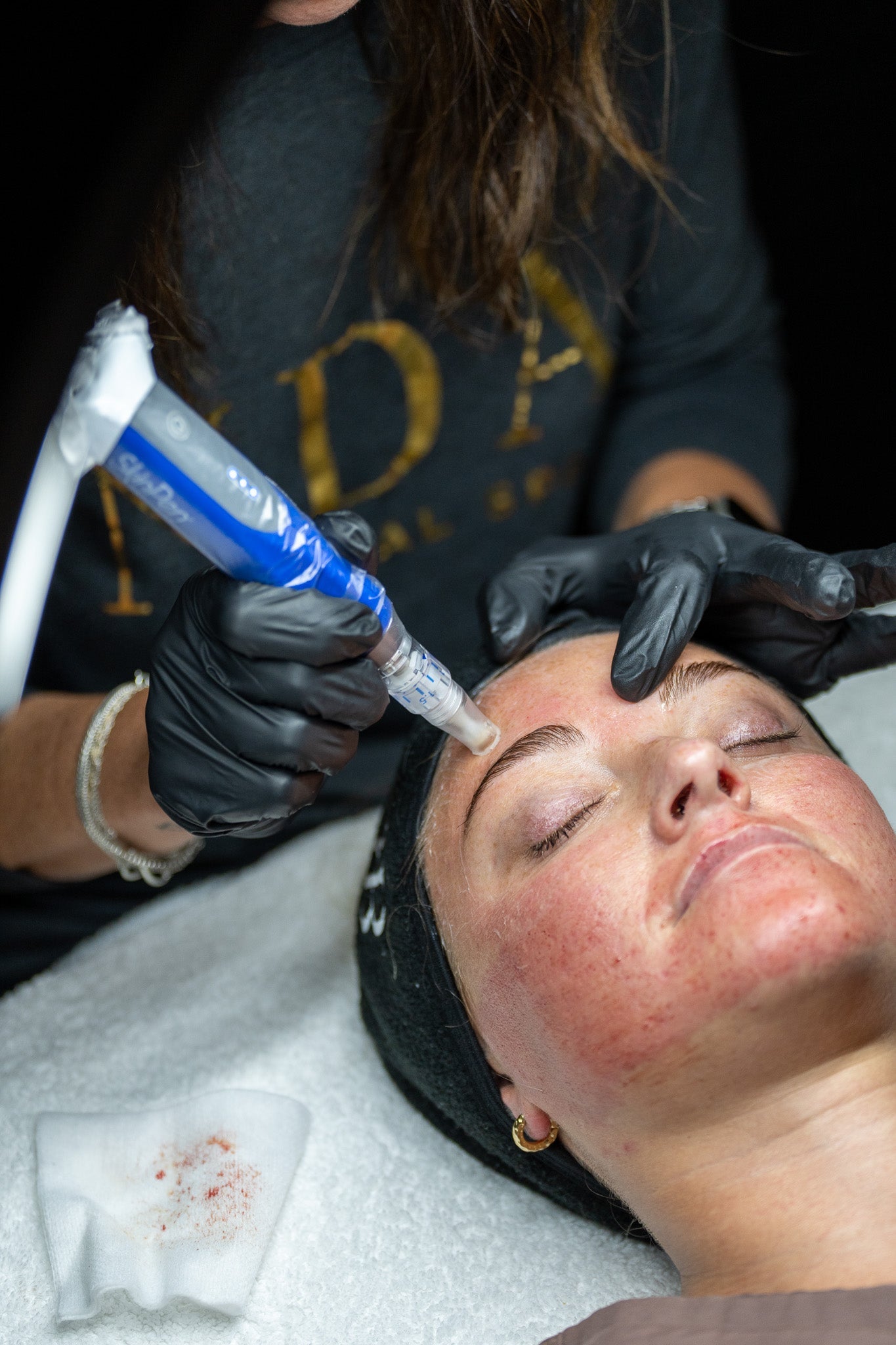 The Benefits of SkinPen: Elevating Your Skincare with Microneedling