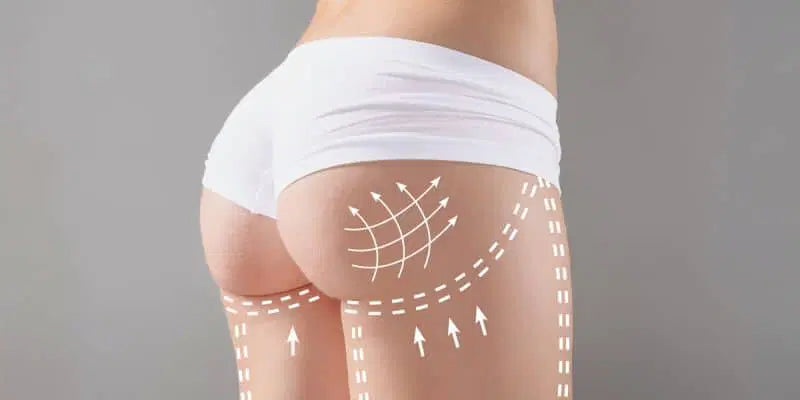 Non Surgical Brazilian Butt Lift